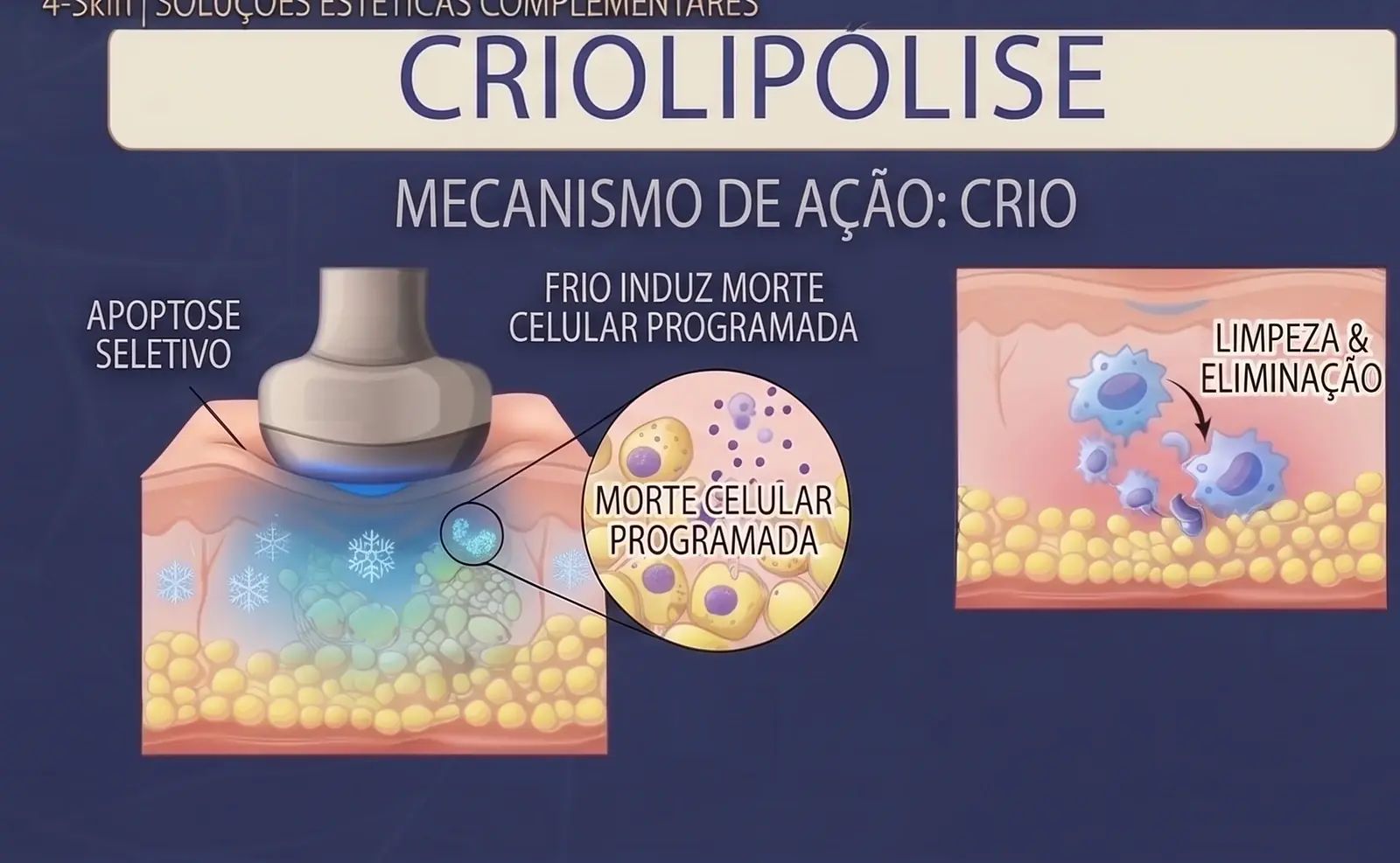 Criolipólise ou cavitação: diferenças e como escolher