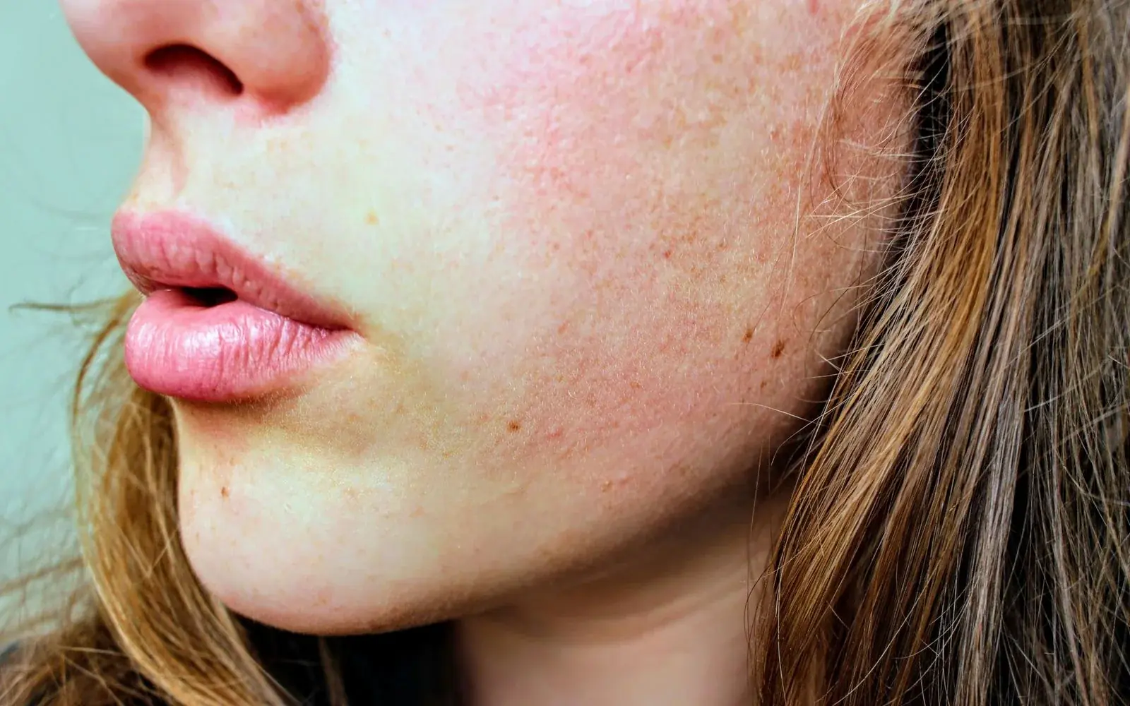 Rosácea na estética: reconhecer fenótipos e trabalhar com referenciação