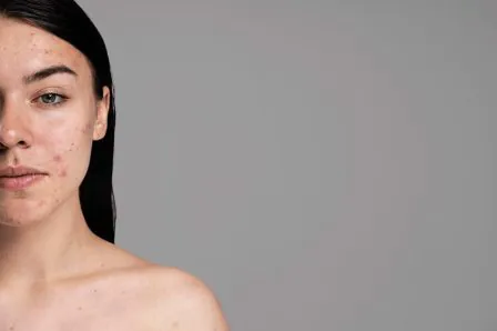 Tratamento de Acne em Clínica Estética: Soluções de Equipamentos 4SKIN